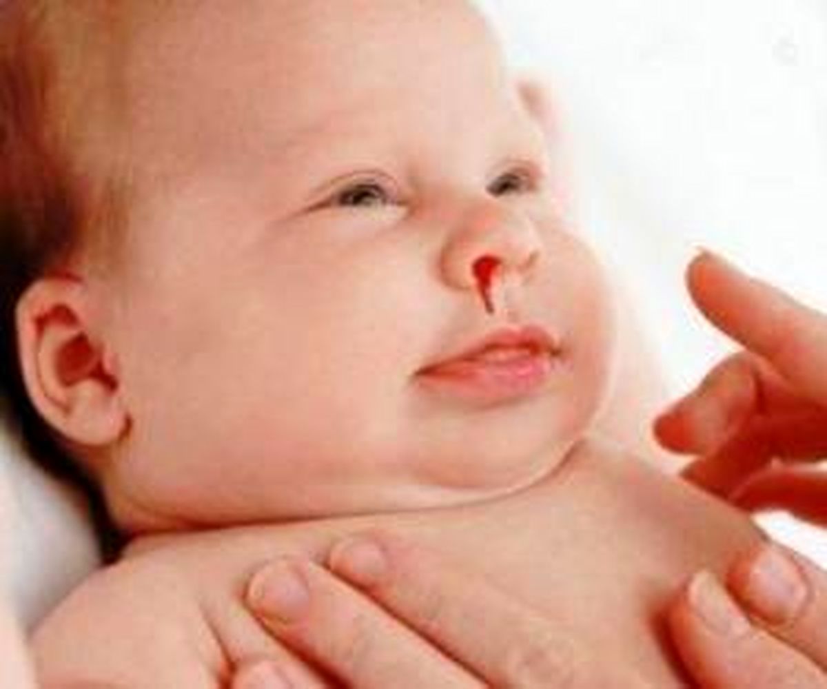 
علل خون دماغ نوزاد و کودک خردسال