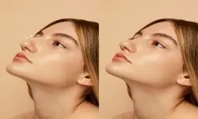 عمل بینی خیلی طبیعی از صفر تا صد