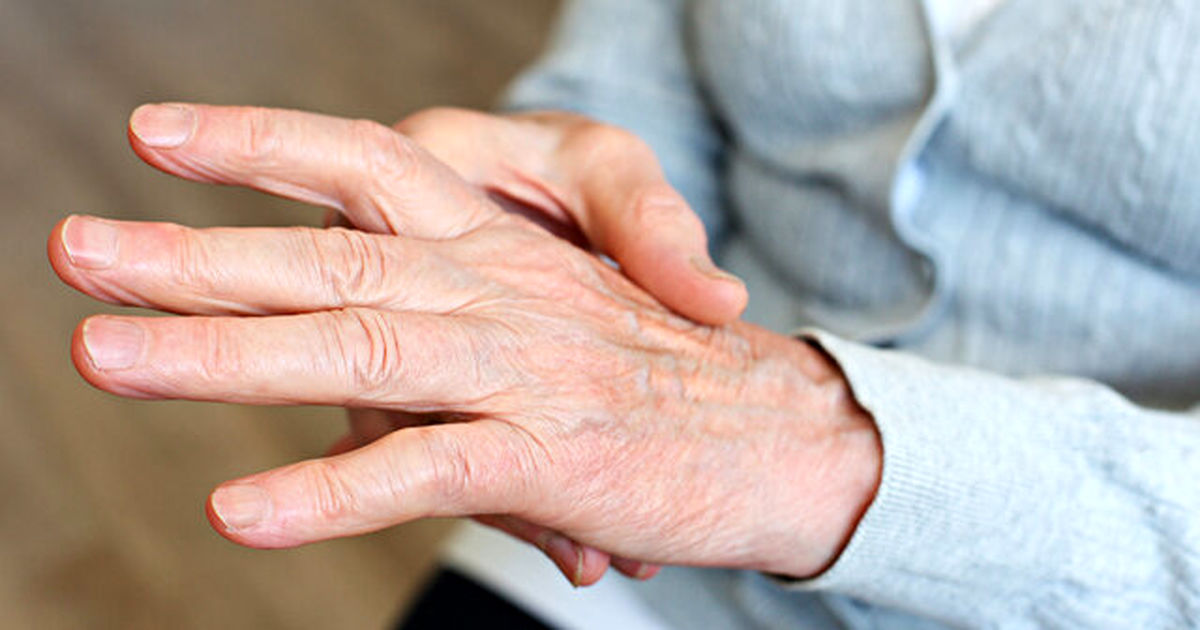 بهبود علائم آرتروز دست با دارویی مقرون به صرفه