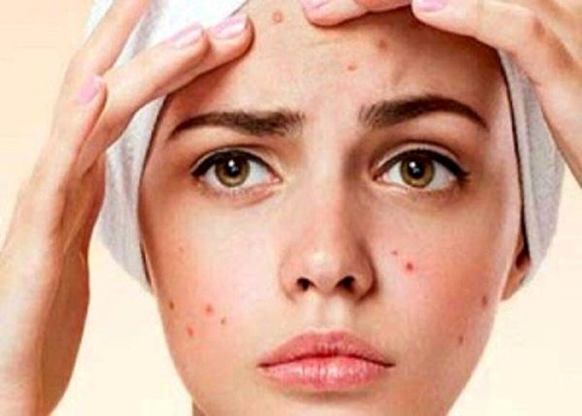 سادهترین روش از بین بردن جای جوش روی صورت