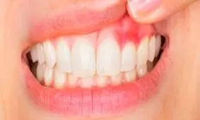 هشدار؛ این علائم در دهان نشان‌دهنده سرطان است/ جدی بگیرید