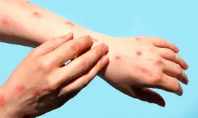 چطور دانه‌ های پوستی آبله میمونی را تشخیص دهیم؟