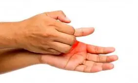 خارش کف دست، خبر از پول می‌دهد یا بیماری؟