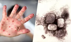 بهبود خود به خودی آبله میمون در افراد عادی بین ۲ تا ۴ هفته