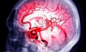 چگونه از سکته مغزی جلوگیری کنیم؟
