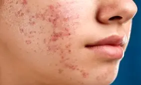 عارضه‌های پوستی که ریشه در سبک تغذیه ناسالم دارند

