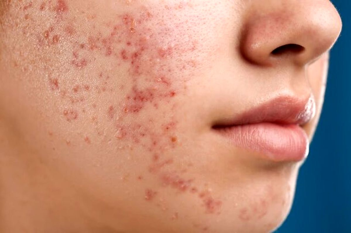 عارضههای پوستی که ریشه در سبک تغذیه ناسالم دارند