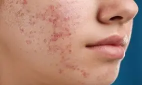 عارضه‌های پوستی که ریشه در سبک تغذیه ناسالم دارند

