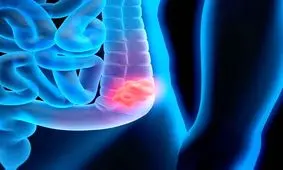 علائم سرطان روده چیست؟