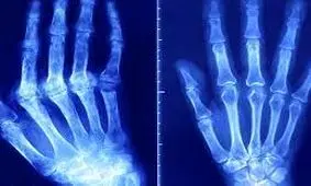 رژیم غذایی غربی؛ عامل شیوعِ جهانیِ بیماری های خودایمنی