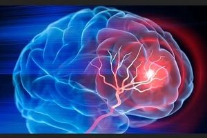 ۴ ساعت نخست؛ زمان طلایی نجات بیماران سکته مغزی