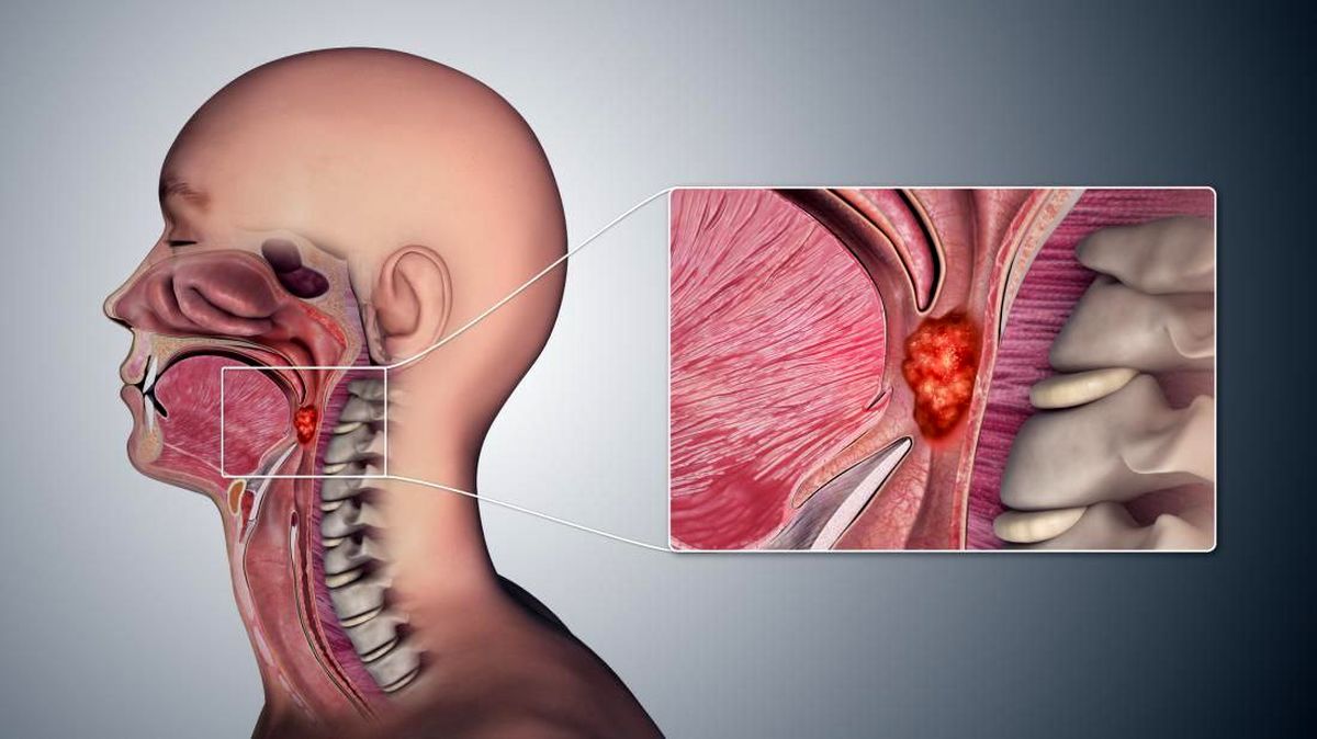 نتایج تحقیقات دانشمندان: رابطه جنسی دهانی از عوامل اصلی ابتلا به سرطان گلو است