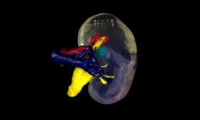 درمان هدفمندتر سرطان کلیه با کمک تومورهای چاپ سه‌بعدی

