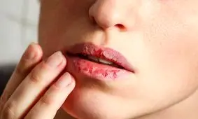 خشکی لب‌ها بر اثر کمبود این ویتامین در بدن به وجود می‌آید