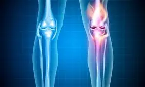 آمار ۱۵ درصدی آرتروز در ایرانیان / تعویض مفصل؛ درمان نهایی این بیماری