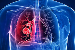 بهترین آنتی بیوتیک و داروی عفونت ریه کدام است؟
