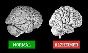 آلزایمر چیست، نشانه هایش کدام است و چه کنیم مبتلا نشویم؟