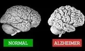 آلزایمر چیست، نشانه هایش کدام است و چه کنیم مبتلا نشویم؟