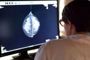 هوش مصنوعی در تشخیص سرطان پستان «امیدبخش» بوده است