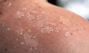 نخستین نشانه ها از سرطان پوست ‌