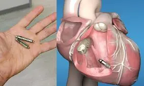 اولین ضربان‌ساز دو حفره‌ای بدون سرب در قلب یک بیمار ۱۳ ساله کاشته شد

