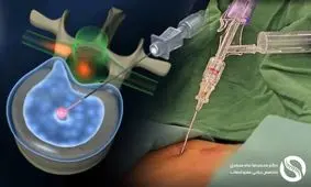 جراحی لیزری دیسک کمر: درمان کمردرد بدون خونریزی (کاندیداها، مزایا و نتایج)