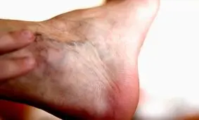 شاغلان در معرض ابتلا به واریس