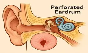 آیا پارگی پرده گوش را می توان درمان کرد؟