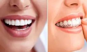 9 مزیت بزرگ ارتودنسی نامرئی نسبت به ارتودنسی های دیگر
