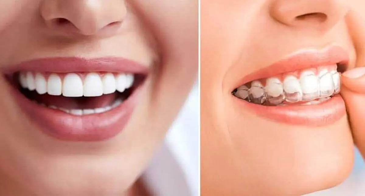9 مزیت بزرگ ارتودنسی نامرئی نسبت به ارتودنسی های دیگر