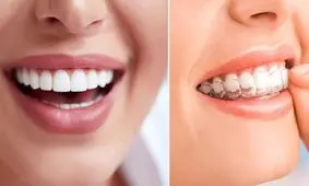 9 مزیت بزرگ ارتودنسی نامرئی نسبت به ارتودنسی های دیگر