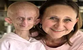 ستاره تیک تاکی مبتلا به پیری زودرس در ۱۹ سالگی درگذشت 