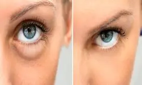 از بین بردن پف زیر چشم با چند روش ساده