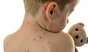 جهان در معرض یک بیماری قدیمی اما فراموش شده