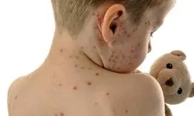 جهان در معرض یک بیماری قدیمی اما فراموش شده