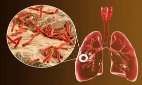 آیا بیماری سل خطرناک است؟