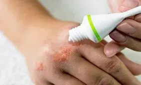 آلرژی های ناشی از محصولات آرایشی، چالشی جدی اما قابل پیشگیری