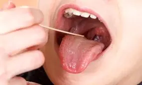 چه کسانی کاندید جراحی برداشتن «لوزه» هستند؟