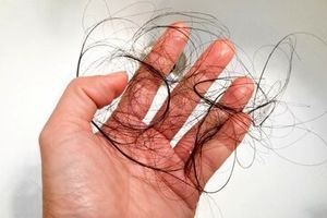 ۲۰ خوراکی برای جلوگیری از ریزش مو