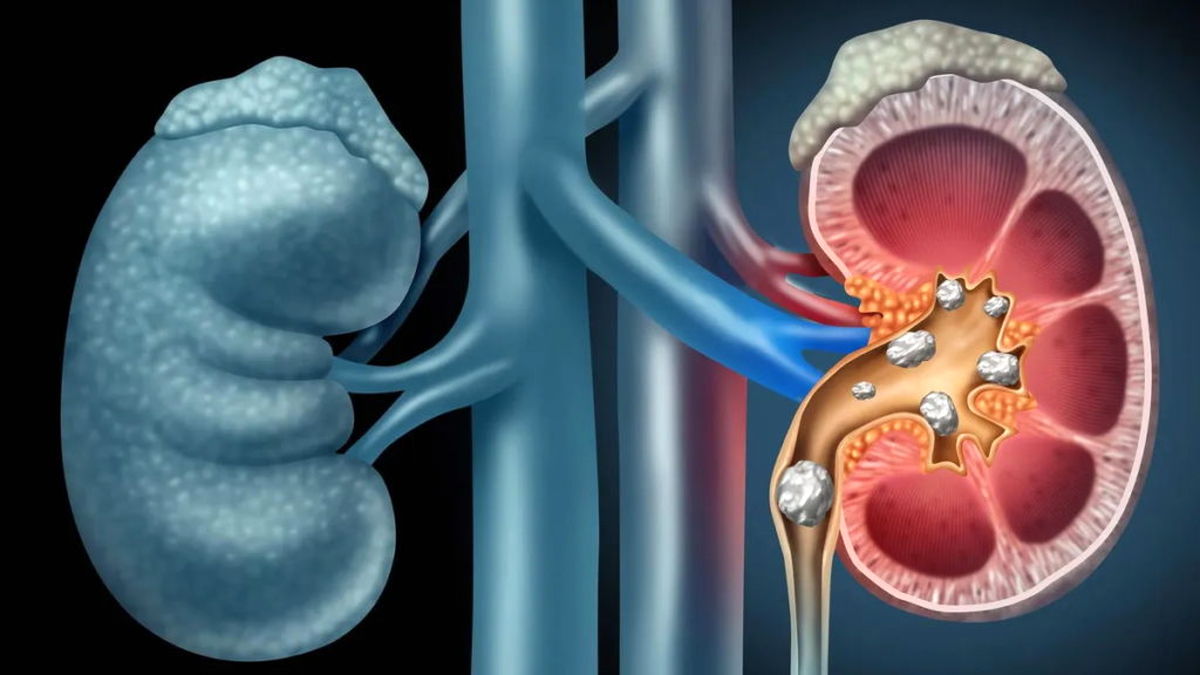 کشف تکنیک جدید برای از بین بردن سنگ کلیه بدون بیهوشی و با کمترین درد