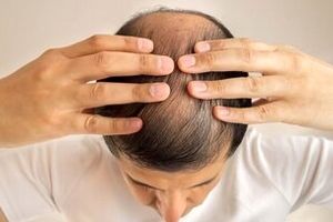 این داروی درمان ریزش مو باعث ایجاد افکار خودکشی می‌شود