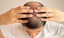 این داروی درمان ریزش مو باعث ایجاد افکار خودکشی می‌شود