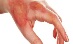 زنگ خطر سوختگی در زمستان؛ هشدار درباره بخاری‌های غیراستاندارد


