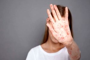 ابتلای هزار نفر به سرخک