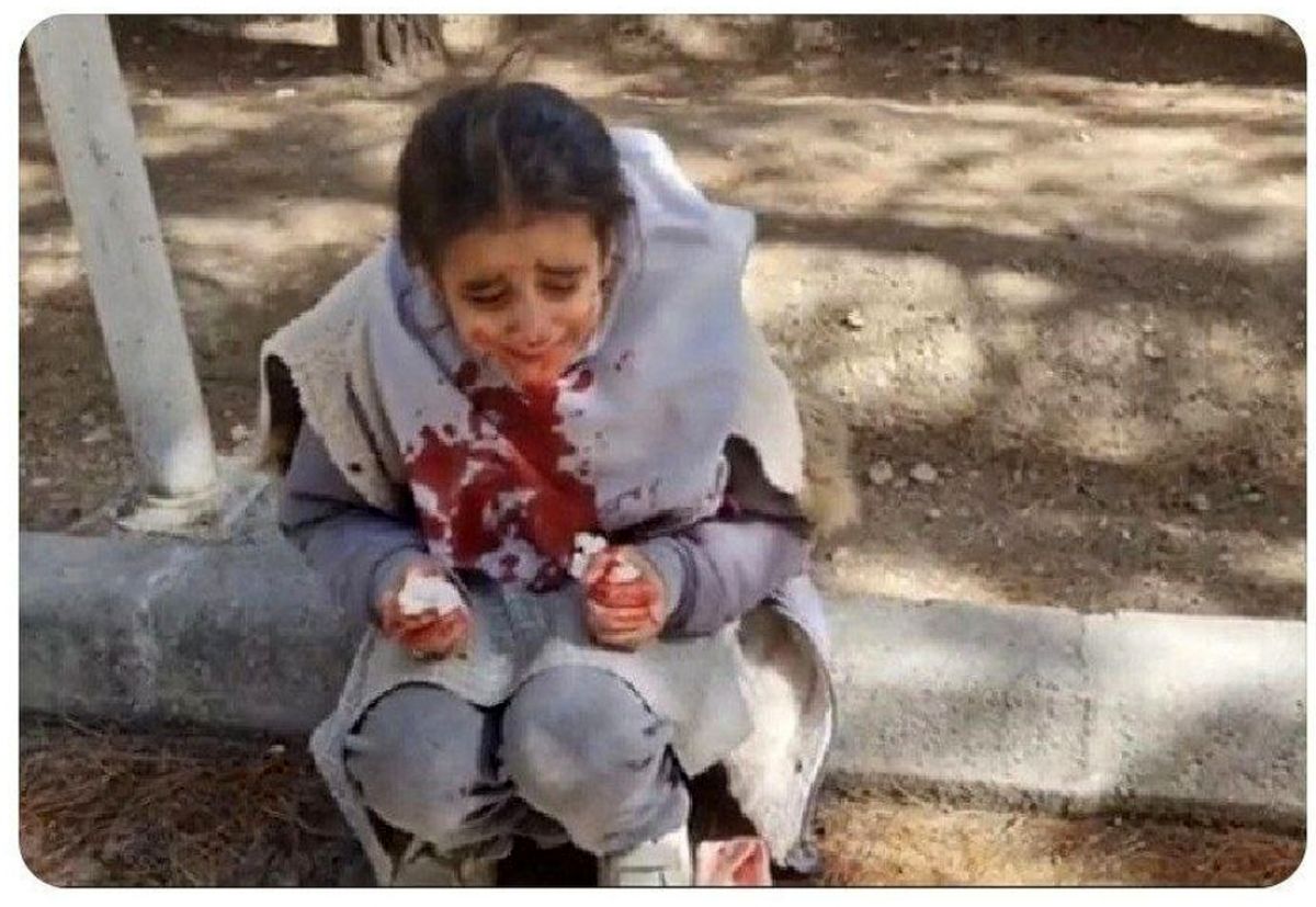 ماجرای صورت خون‌آلود دانش‌آموز اصفهانی چیست؟/ پیگیری ها در مورد ربط موضوع با حجاب، ادامه دارد
