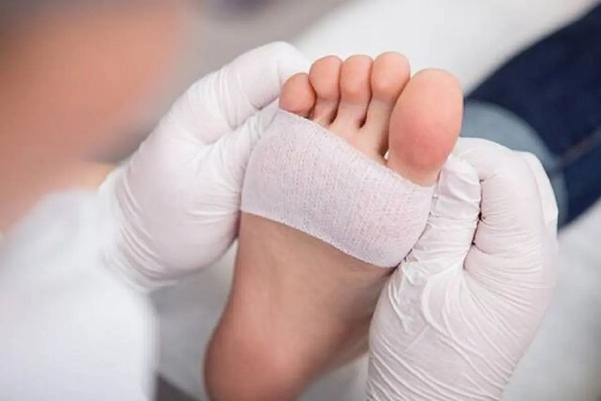 ترکیب هیدروژل و اگزوزم به کمک زخم‌های دیابتی می‌آیند

