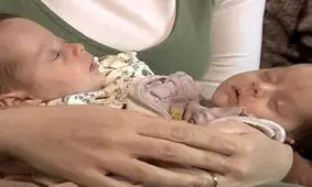 آنابل و ایزابل، دوقلوهای به‌هم چسبیده‌