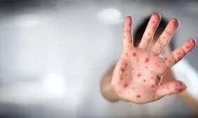 نکات پیشگیرانه بیماری آبله میمونی مشابه روش‌ های پیشگیری از کرونا است