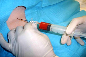 علل و راههای درمان سردرد پس از تزریق اپیدورال