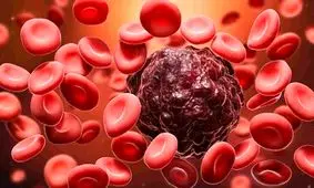 علائم ناشناخته سرطان خون